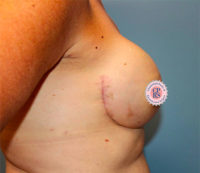 Nipple Sparing Reconstruction