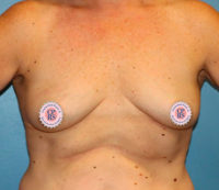 Nipple Sparing Reconstruction