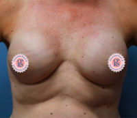 Nipple Sparing Reconstruction