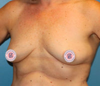 Nipple Sparing Reconstruction