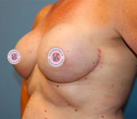 Nipple Sparing Reconstruction