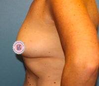 Nipple Sparing Reconstruction