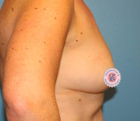 Nipple Sparing Reconstruction