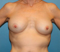 Breast Implant Removal