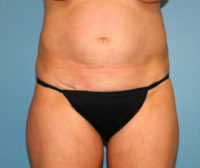 Tummy Tuck