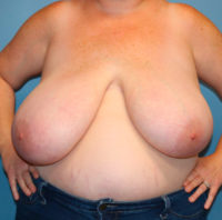 Breast Reduction