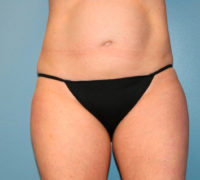 Tummy Tuck