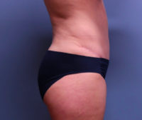 Tummy Tuck