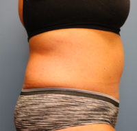Tummy Tuck