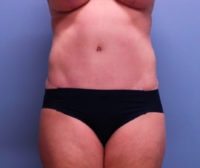 Tummy Tuck