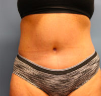 Tummy Tuck