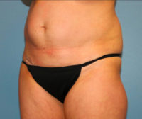 Tummy Tuck