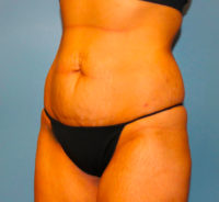 Tummy Tuck