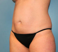 Tummy Tuck