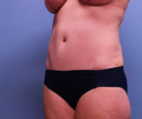 Tummy Tuck