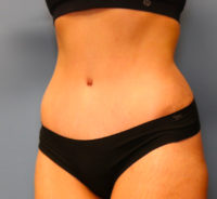 Tummy Tuck