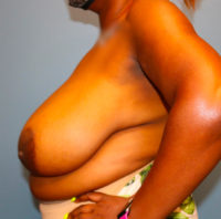 Breast Reduction