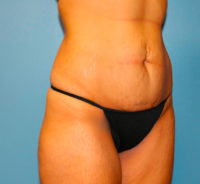 Tummy Tuck