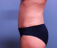 Tummy Tuck