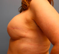 Skin Sparing Reconstruction