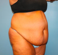Tummy Tuck