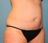 Tummy Tuck