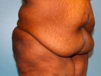 Panniculectomy
