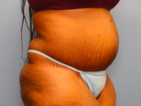 Panniculectomy