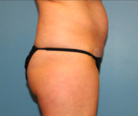 Tummy Tuck