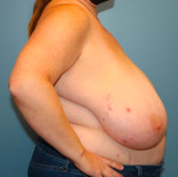 Breast Reduction