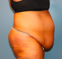 Tummy Tuck