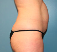 Tummy Tuck