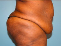 Panniculectomy
