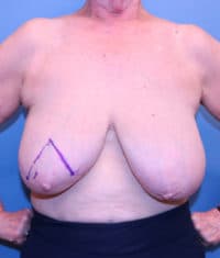 Oncoplastic Breast Reconstruction