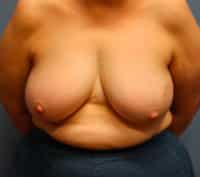 Oncoplastic Breast Reconstruction