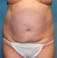 Tummy Tuck