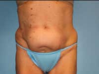 Tummy Tuck