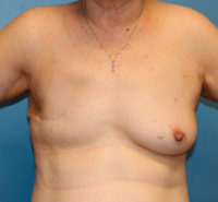 Skin Sparing Reconstruction