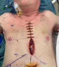 Complex Chest, Abdomen, & Pelvic Reconstruction