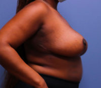 Breast Reduction