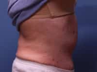 Tummy Tuck
