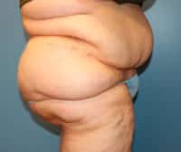 Panniculectomy