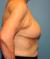 Oncoplastic Breast Reconstruction