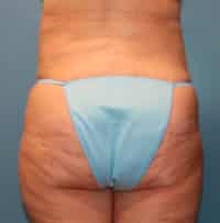 Tummy Tuck