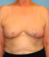 Oncoplastic Breast Reconstruction