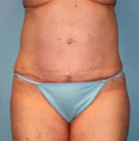 Tummy Tuck