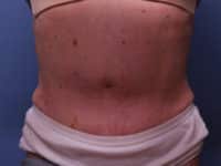 Tummy Tuck