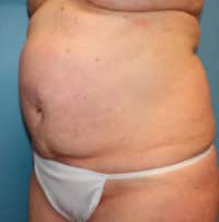 Tummy Tuck