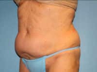 Tummy Tuck