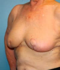 Oncoplastic Breast Reconstruction